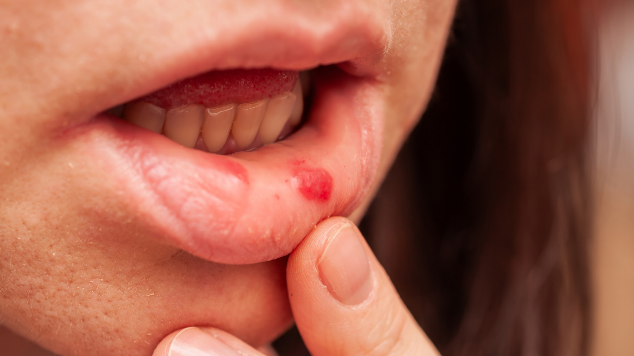 agiz-ici-yaralari-neden-olusur-ve-nasil-gecer