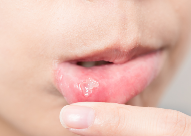 Tekrarlayan Ağız İçi Yaraları Nasıl Geçebilir?