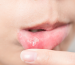 Tekrarlayan Ağız İçi Yaraları Nasıl Geçebilir?