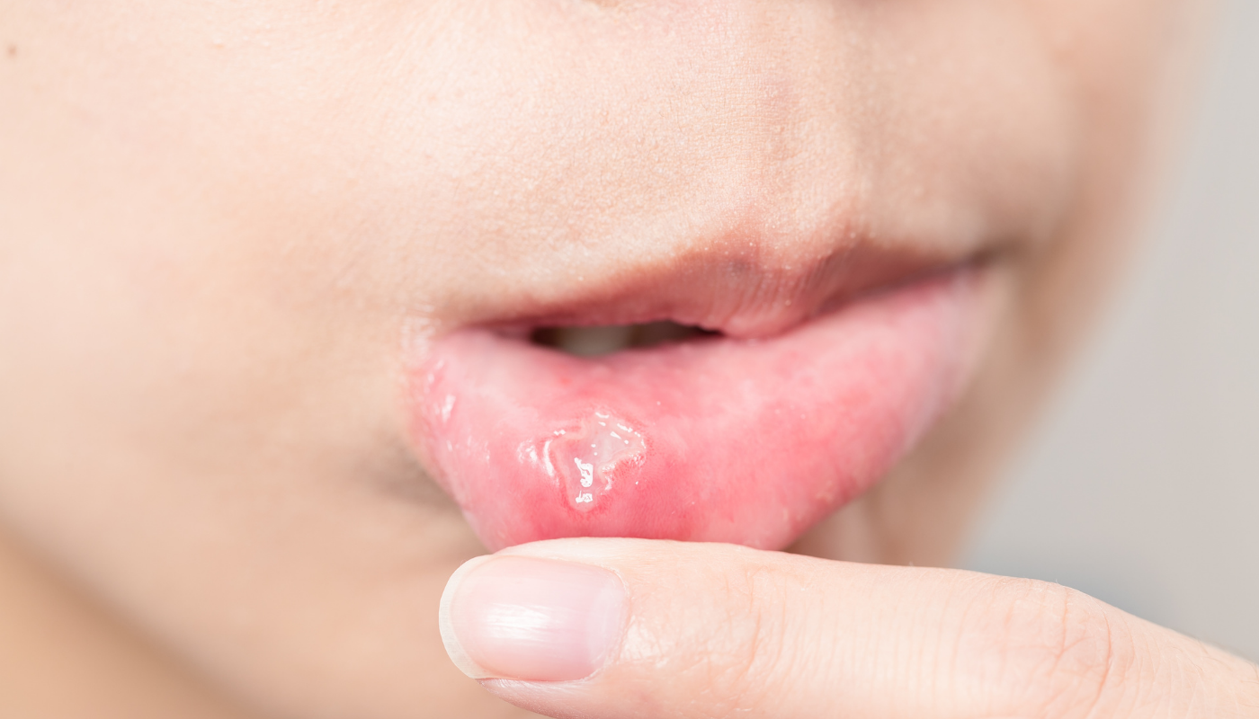 Tekrarlayan Ağız İçi Yaraları Nasıl Geçebilir?