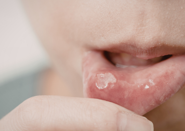 cocuklarda-agiz-ici-yaralari-neden-tekrarlar