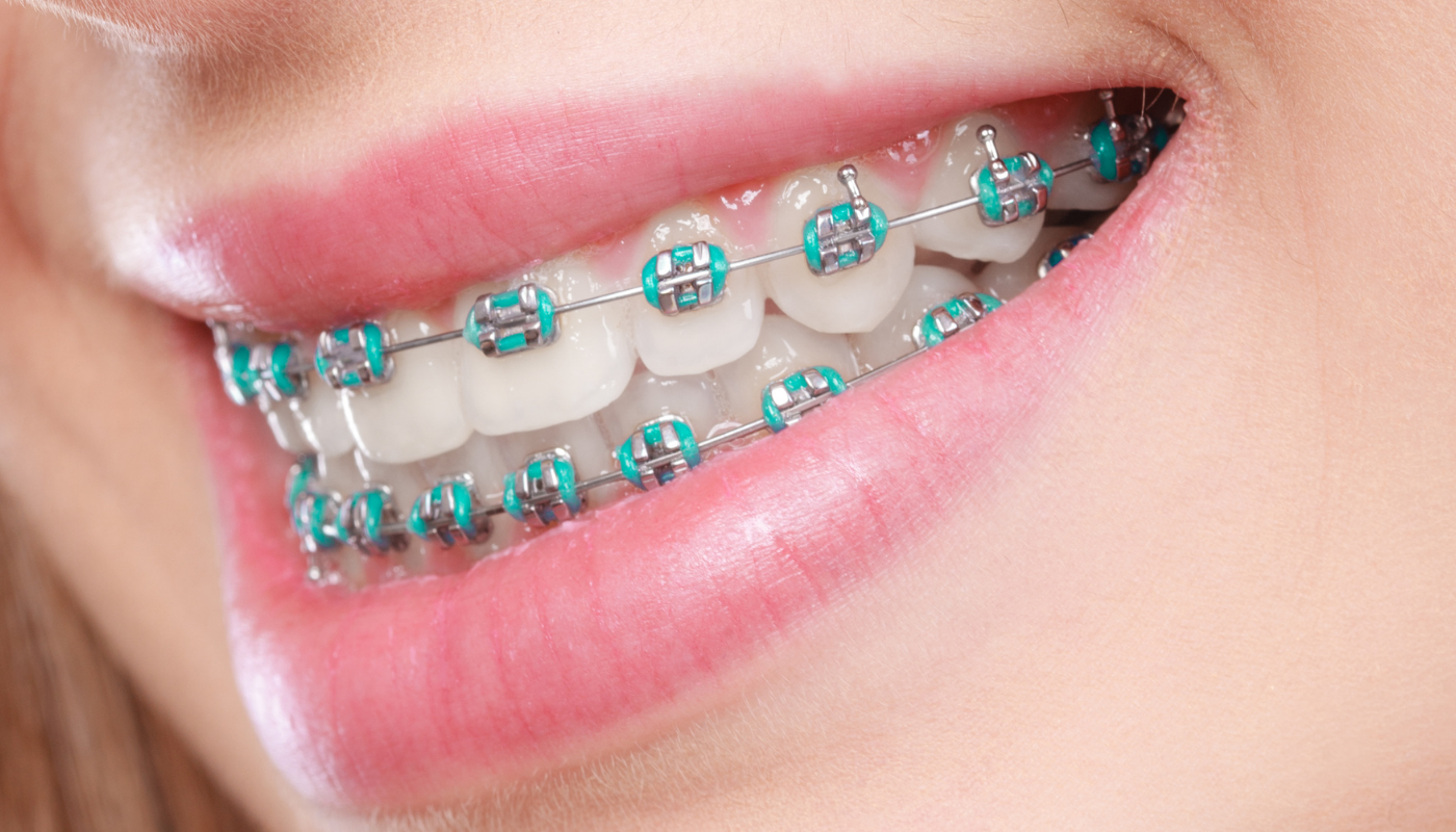 Diş Teli Kullanırken Neden Daha Dikkatli Temizlik Gerekir?