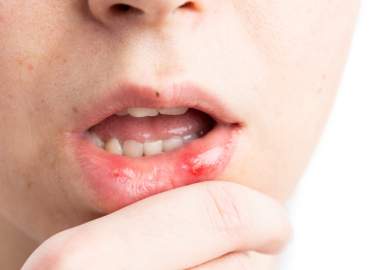 Close-up of a chin and lips with a red irritated sore on the inner lower lip, finger near the mouth.