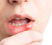 Close-up of a chin and lips with a red irritated sore on the inner lower lip, finger near the mouth.