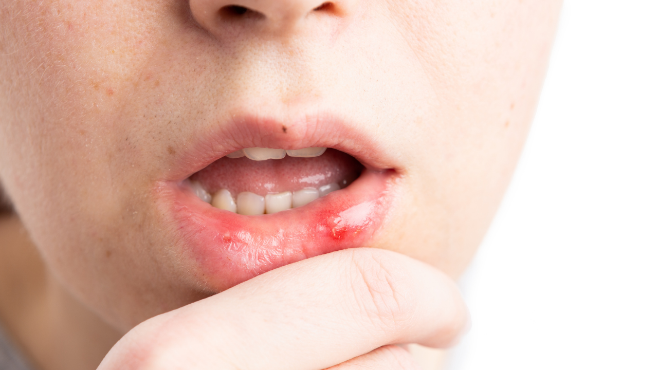 Close-up of a chin and lips with a red irritated sore on the inner lower lip, finger near the mouth.